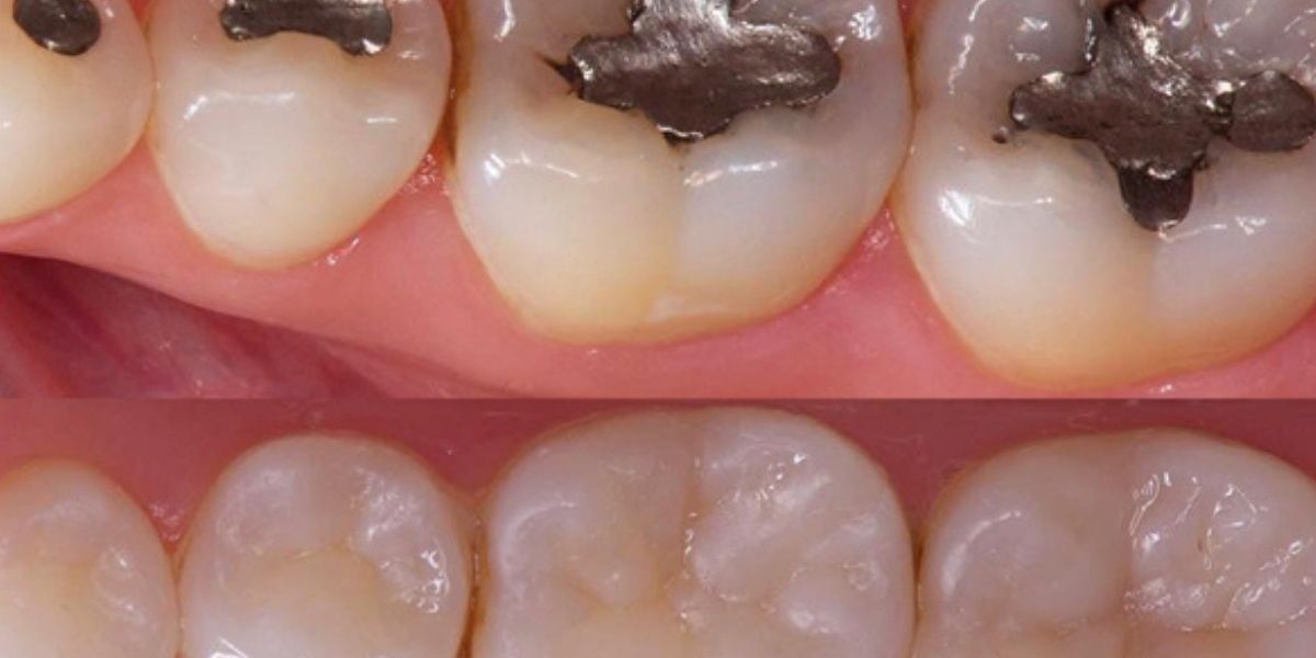 ¿Conoce qué es la caries dental, sus fases y cómo tratarla?